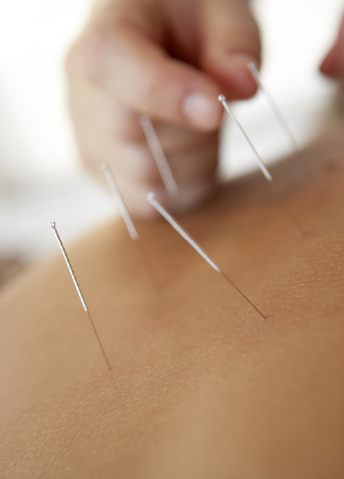 Acupuncture